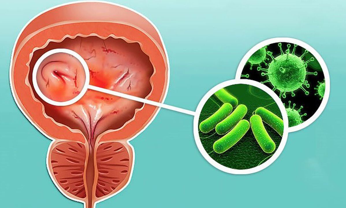 ¿Cómo se desarrolla la cistitis 