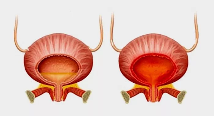 Vejiga normal (izquierda) e inflamación de la vejiga con cistitis (derecha)